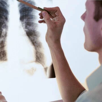 Tatamento de cancer de pulmon em Boa Vista RR com Dr Amon